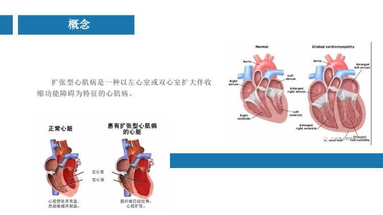 中国最新心肌扩张治疗技术及其步骤指南