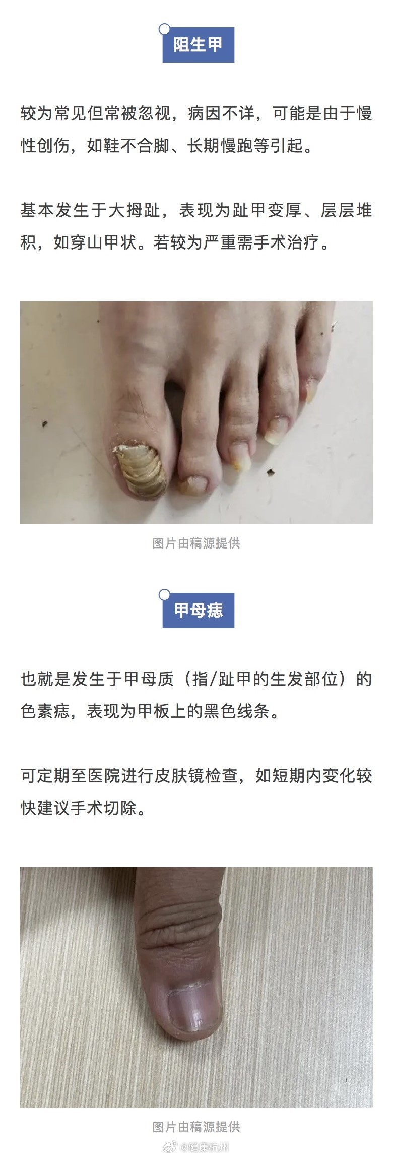 最新甲病防治与护理步骤指南全解析